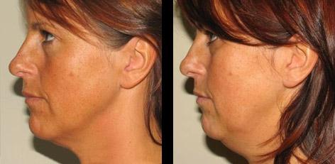 Rejuvenecimiento facial sin cirugía como una innovación en cosmetología