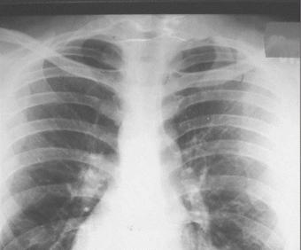 grasa de tejón en tuberculosis